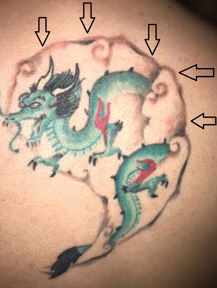 How To Clean An Infected Tattoo In 6 Steps  AuthorityTattoo