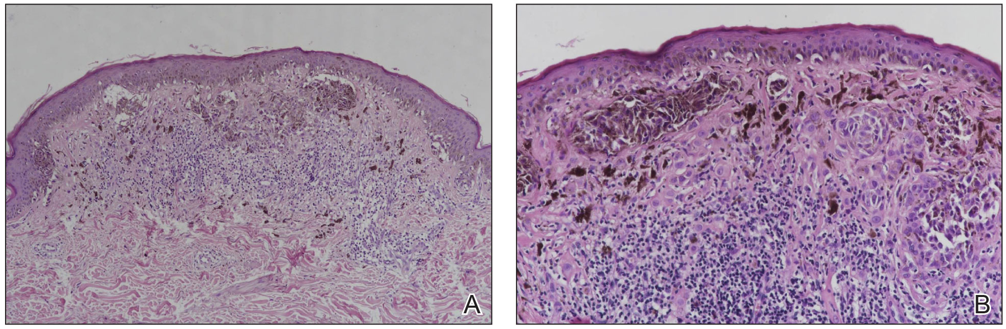 A, Histopathology showed an asymmetric lesion with atypical melanocytes singly and in nests disposed both at the junction and superficial dermis as well as notable dermal inflammation (H&E, original magnification ×100). B, Higher magnification showed derm