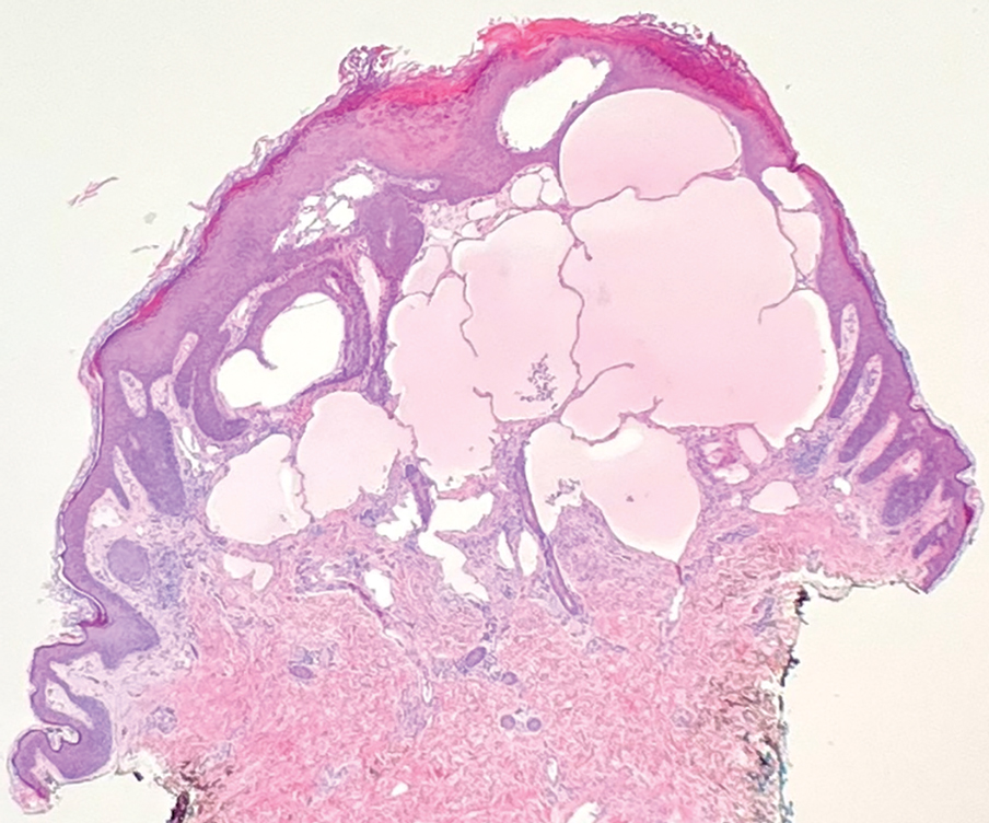 An unencapsulated proliferation of anastomosing vascular spaces within the papillary and reticular dermis (H&E, original magnification ×20).