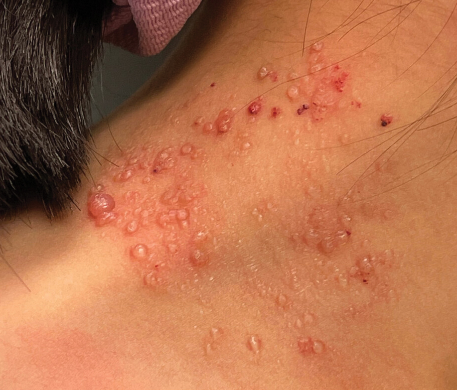 Clustered vesicles on the neck
