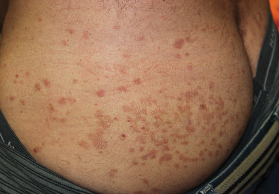 Rash After Testosterone Injection