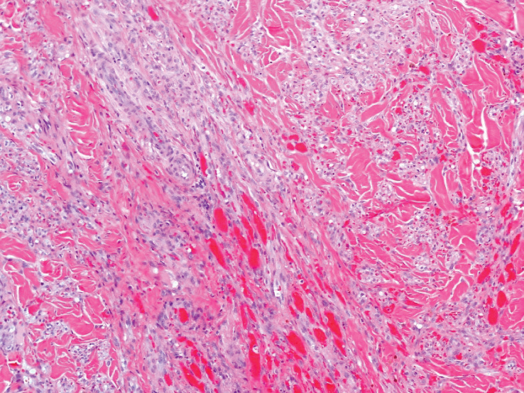 Haphazardly arranged spindle cells in the dermis with punctate and expanded vascular slits (H&E, original magnification ×100).