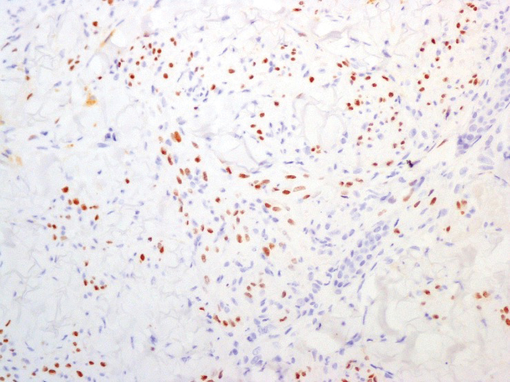 Human herpesvirus 8 immunostaining with nuclear expression in neoplastic cells (original magnification ×200).