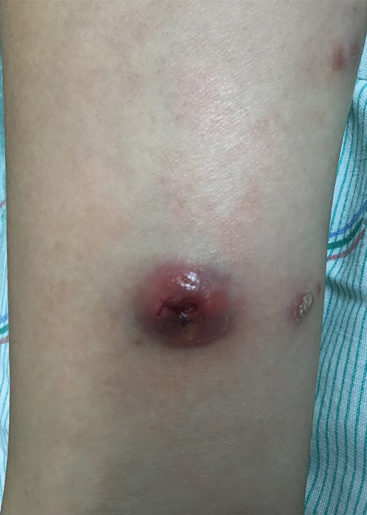 Erythematous nodule with central ulceration. A scaly papule was present on the medial arm