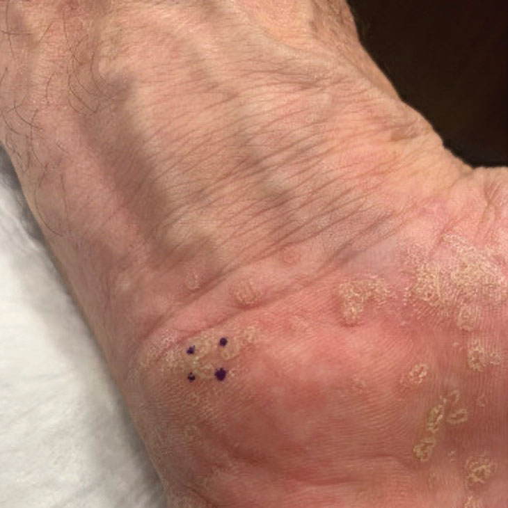 Symmetric palmoplantar papules with a keratotic border