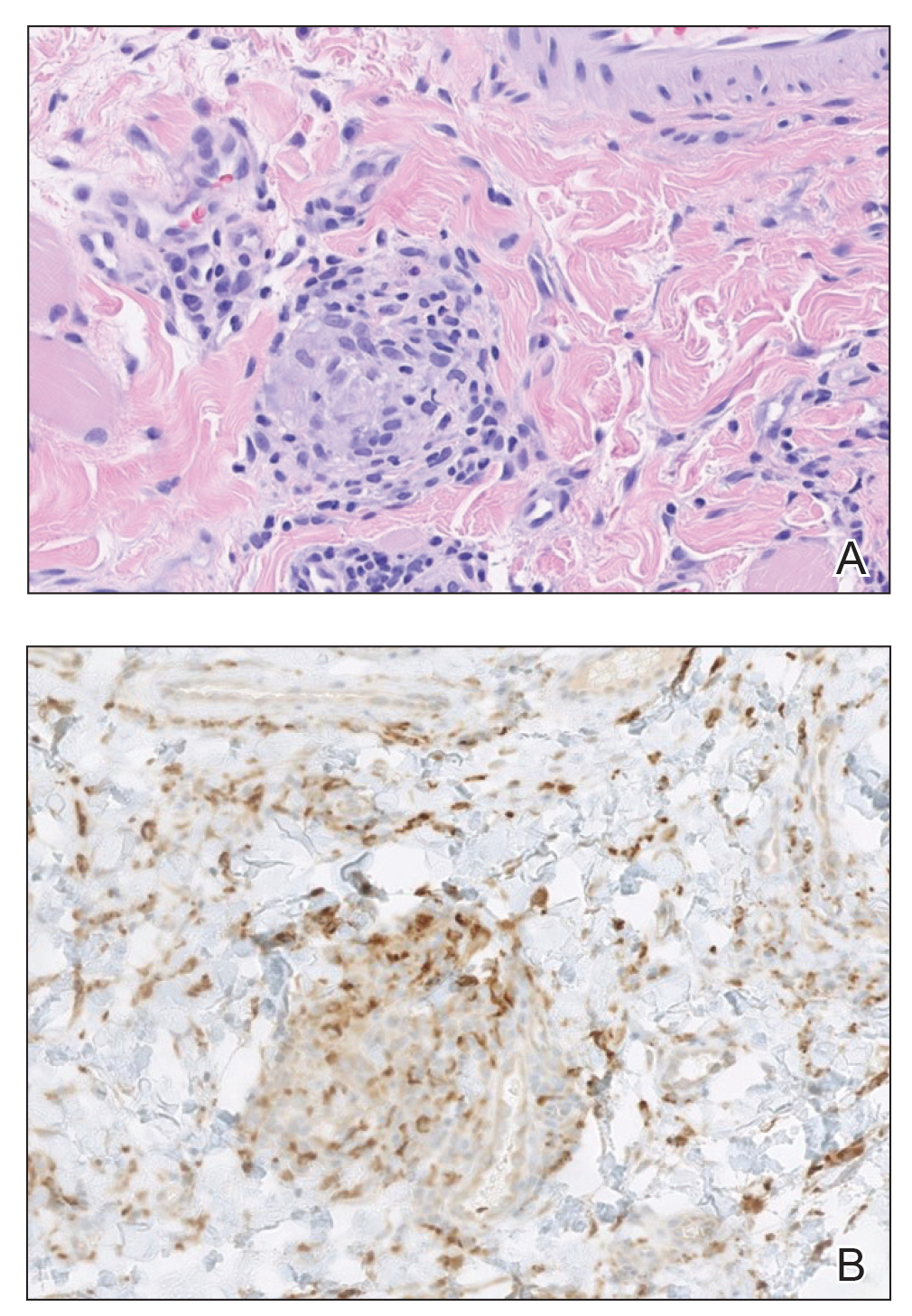 A, A small noncaseating epithelioid granuloma with few lymphocytes (H&E, original magnification ×30). B, CD68 immunostaining showed a cluster of epithelioid histiocytes in the submucosal stroma (original magnification ×30).