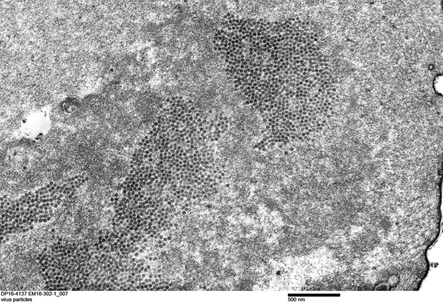 Transmission electron microscopy of an inner root sheath keratinocyte demonstrated intranuclear, organized, crystalloid viral particles measuring 33 to 38 nm in diameter