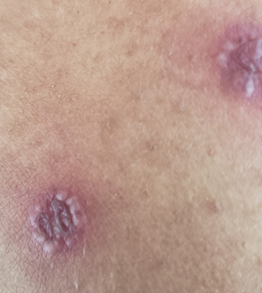 Purpuric plaques on the thigh with peripheral vesiculation