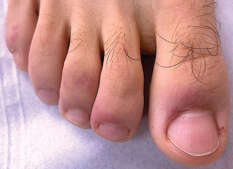 Chilblainlike lesions (so-called COVID toes) manifested with red-violaceous macules over the distal toes.