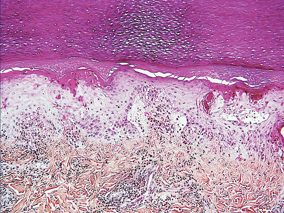 Histopathology of chilblainlike lesions (so-called COVID toes) shows scattered epidermal keratinocyte necroses, severe edema of the papillary dermis, and dermal lymphocytic infiltration (hematoxylin-eosin-saffron, original magnification ×100).