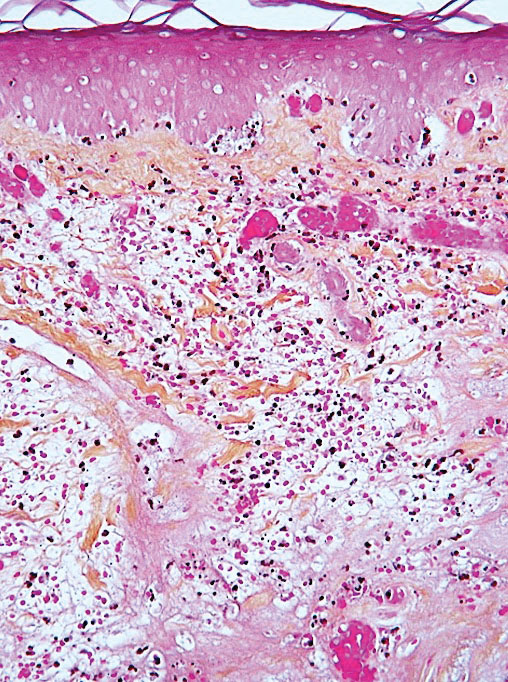 Acro-ischemia livedoid lesions from an elderly patient with severe COVID-19 manifested histologically with epidermal necrosis, dermal capillary thromboses and necroses, red blood cell extravasation (purpura), and a moderately dense diffuse lymphocytic