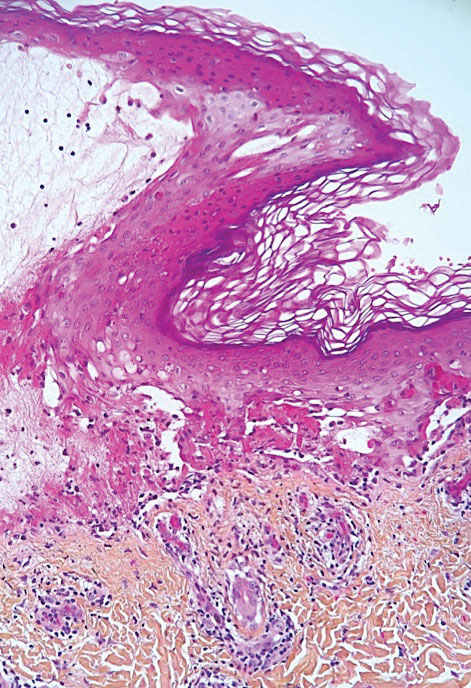 Erythema multiforme–like eruption following COVID-19 infection manifesting histologically with epidermal keratinocyte necroses and dermoepidermal bullae (hematoxylin-eosin-saffron, original magnification ×200).