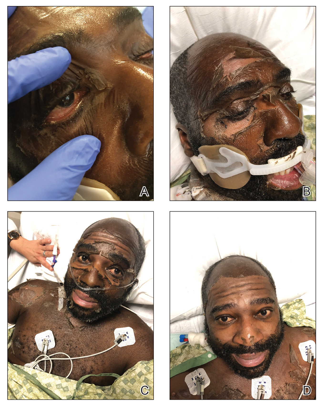 Progression of facial desquamation