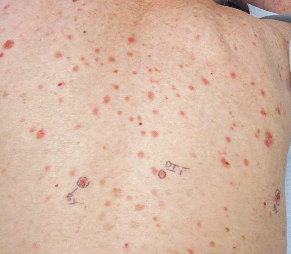 Bright and dusky, erythematous, flat-topped papules and plaques of lichen planus located on the superior and inferior mid back.