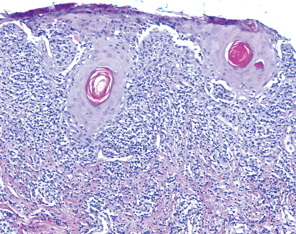 Histopathology of a vulvar lesion revealed a bandlike infiltrate of mononuclear cells that “hugged” the overlying epidermis, a feature diagnostic of lichen planus (H&E, original magnification ×10).
