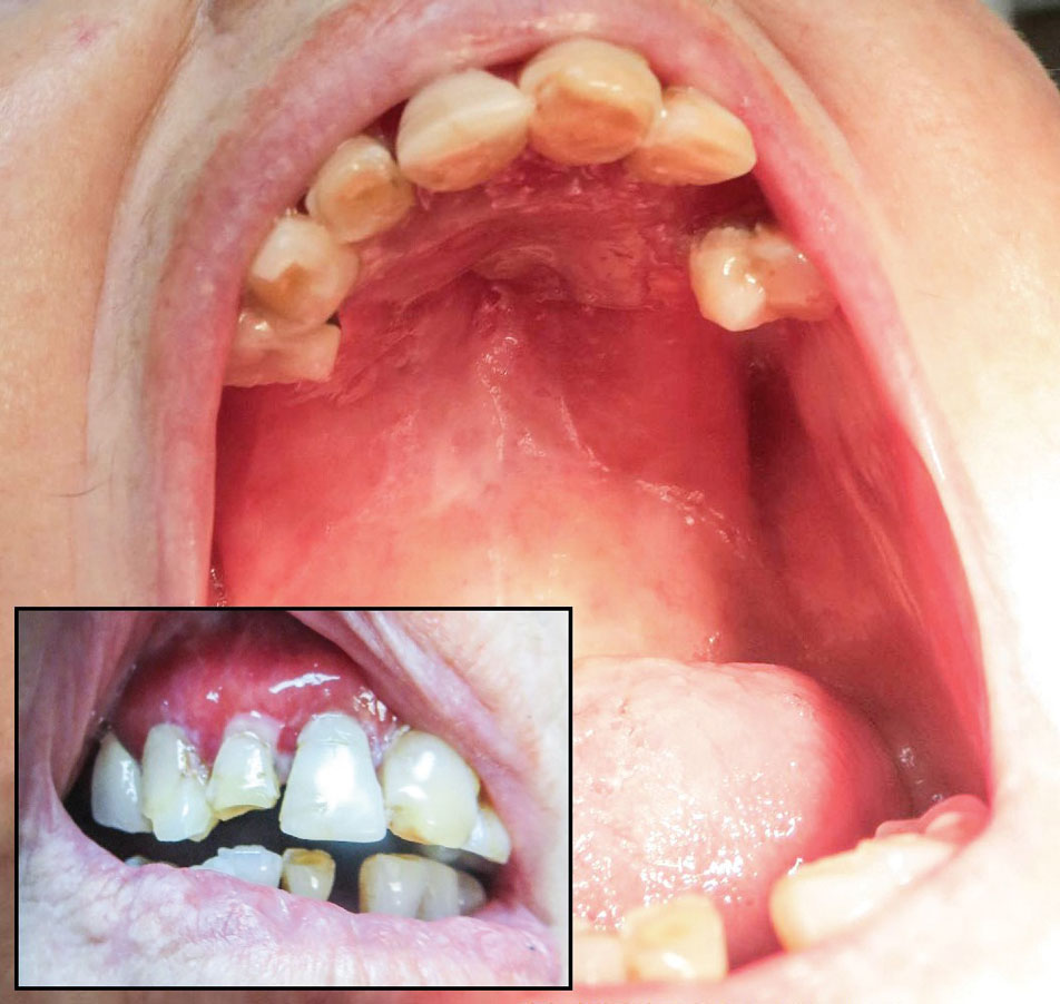 Oral involvement of lichen planus progressed to involve skin sloughing with resultant superficial erosions on the hard palate. Wickham striae were present on the left buccal mucosa and right superior gingivae (insert).