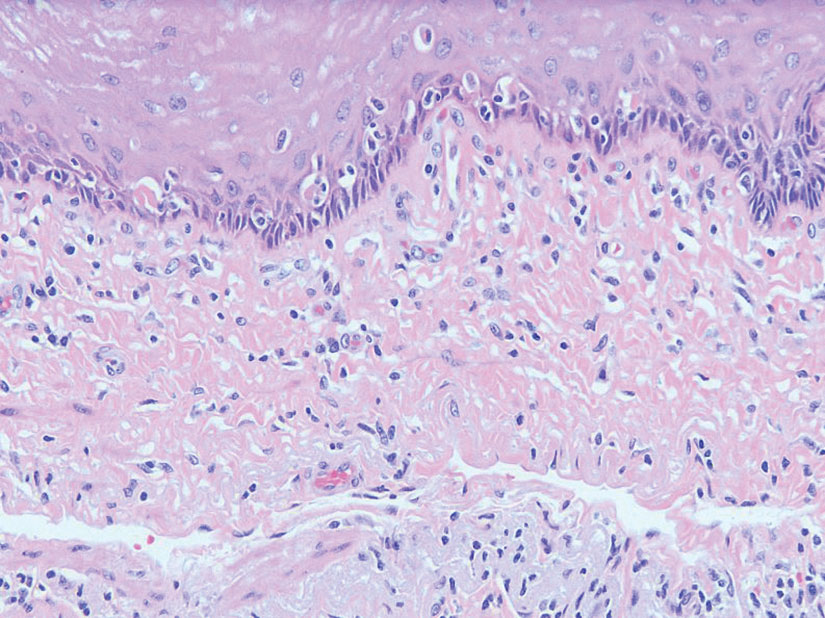 An esophageal biopsy revealed necrotic keratinocytes in the lower epithelium and a mononuclear infiltrate, features diagnostic of esophageal lichen planus (H&E, original magnification ×20).