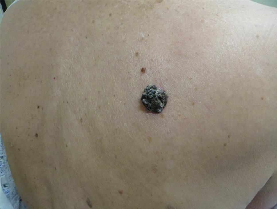 Dark Brown Hyperkeratotic Nodule on the Back