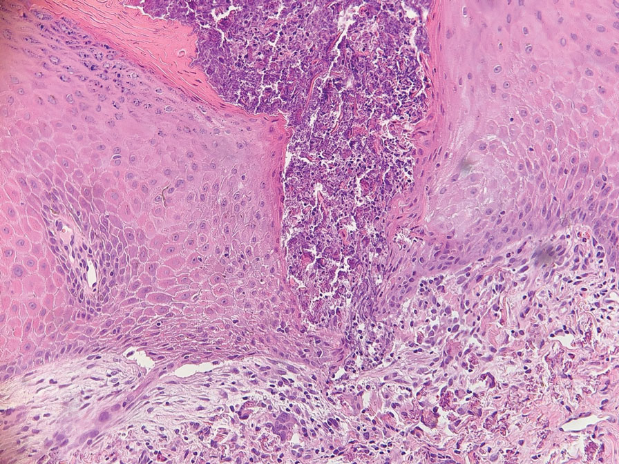 Histopathology showed a transepidermal channel extruding the dermal, eosinophilic, fragmented, curly elastic fibers through the epidermis