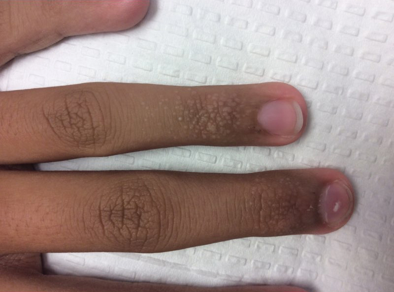 A 14‐year‐old girl with grouped flesh color papules and skin color