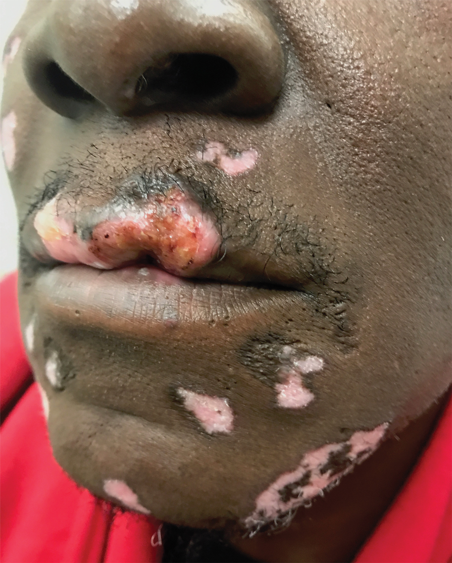 Invasive squamous cell carcinoma arising within a labial discoid lupus erythematosus lesion. This patient’s lesions were present for approximately 6 years prior to presentation for carcinoma.