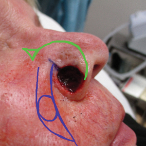  Mohs defect and reconstructive options designed by a fellow in-training (spiral flap in green) and attending physician (melolabial interpolation flap in blue).