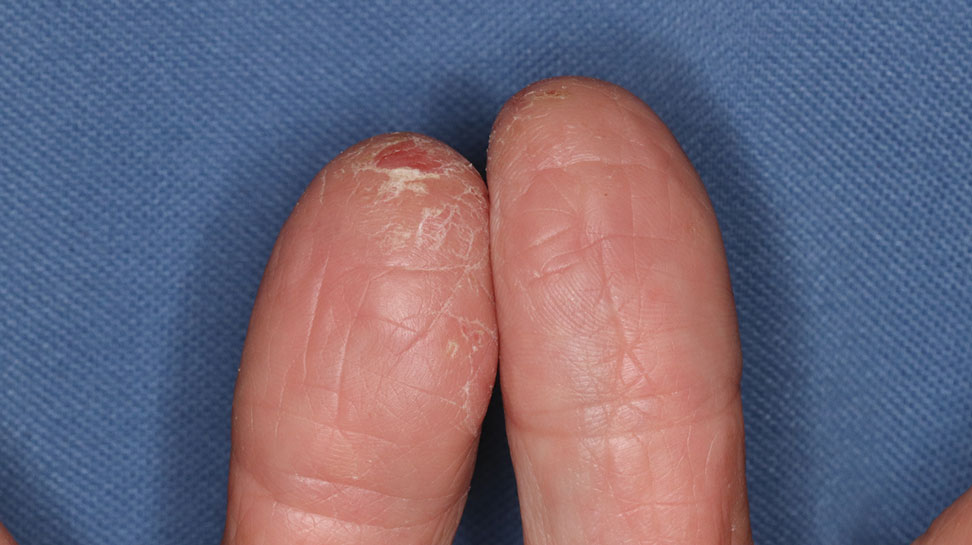 Dermatitis of the hand characterized by erythema and hyperkeratosis caused by tulipalin A in Peruvian lily (Alstroemeria) and resembling so-called tulip fingers caused by Tulipa species and cultivars