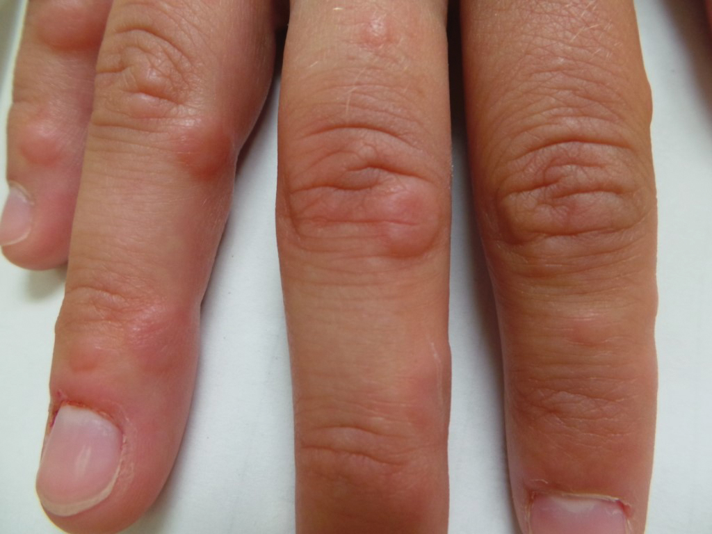 Multiple discrete, erythematous, indurated papules on the dorsal and lateral sides of the fingers.