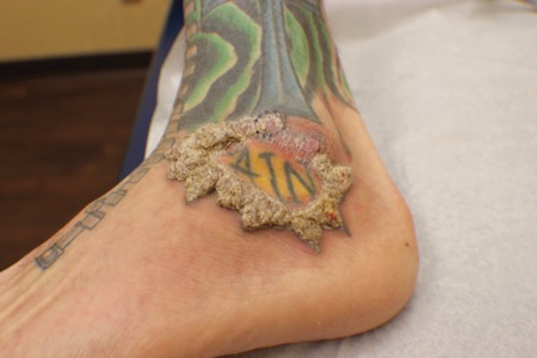 Verruciform Plaques Within a Tattoo of an HIV-Positive Patient | MDedge  Dermatology