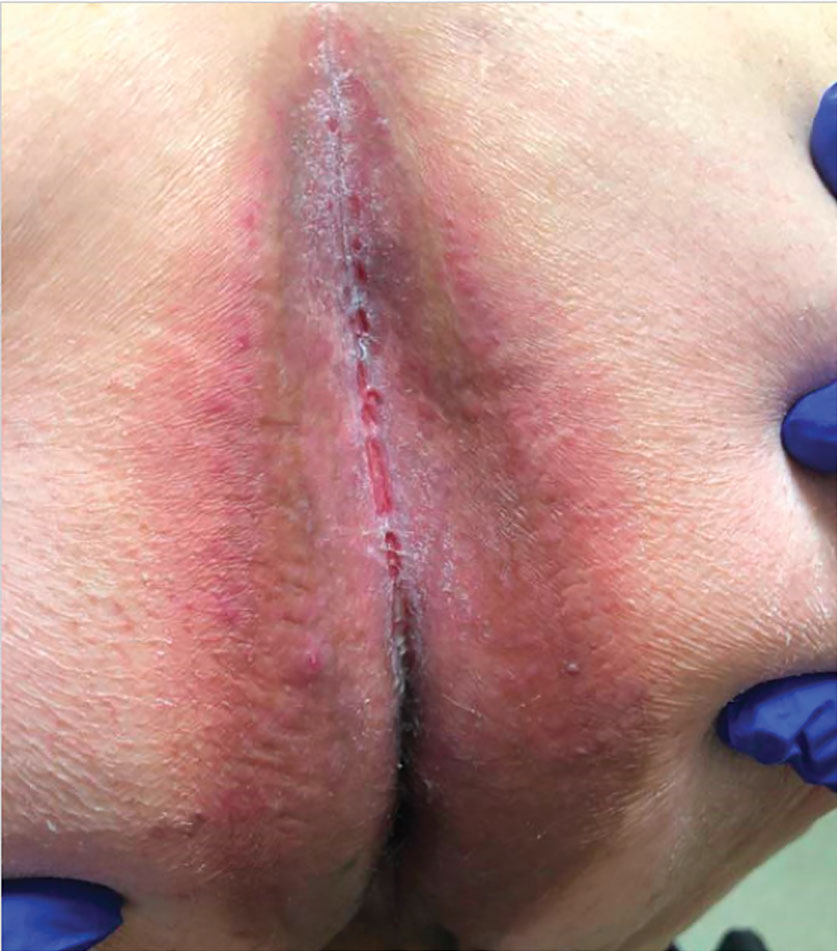 Symmetrical drug-related intertriginous and flexural exanthema in the gluteal cleft of a 65-year-old man 2 weeks after starting lazertinib and amivantamab therapy for stage IV non–small cell lung cancer.