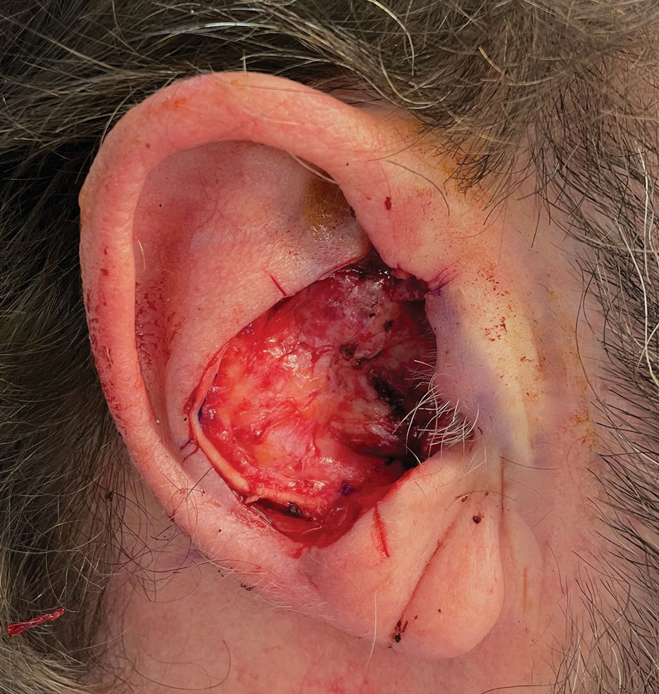 An extensive 5.5×4.2-cm defect of the right conchal bowl following 3 stages of Mohs micrographic surgery for basal cell carcinoma, with complete loss of cartilage throughout the concha, helical crus, and inner rim of the antihelix. The posterior auricular