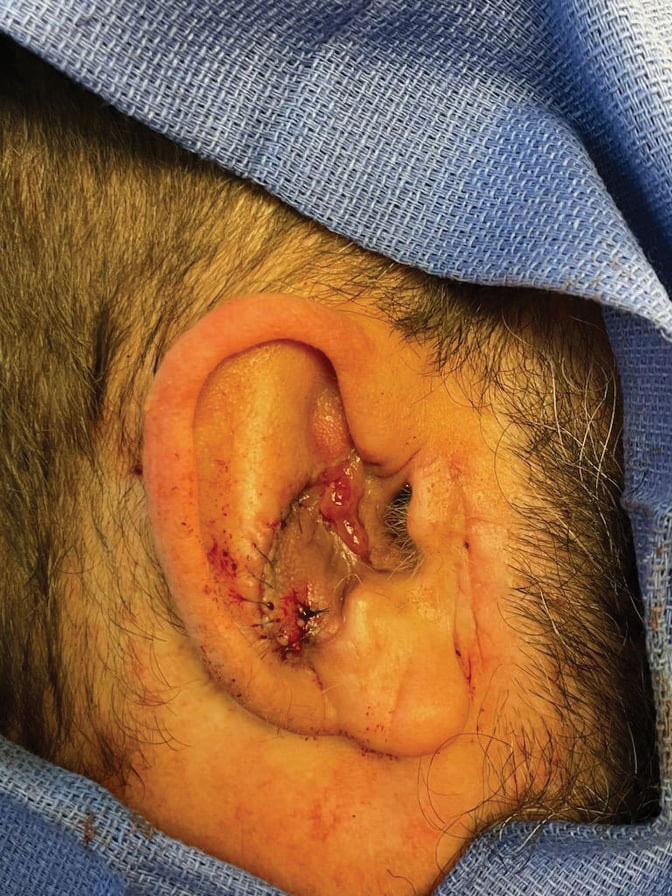 In stage 2 of the repair, the retroauricular flap pedicle was incised and inset into the lateral aspect of the defect.