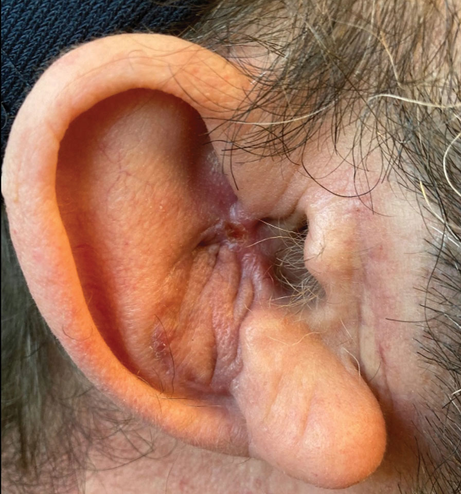 At 1 month following the takedown of the retroauricular pull-through sandwich flap, the surgical site was fully healed with a good aesthetic and functional outcome.