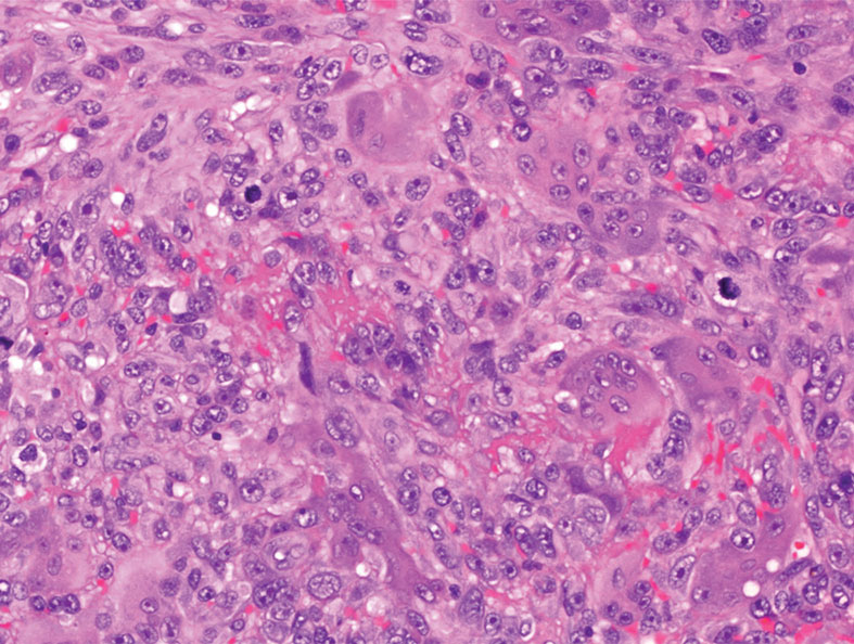 Atypical fibroxanthoma