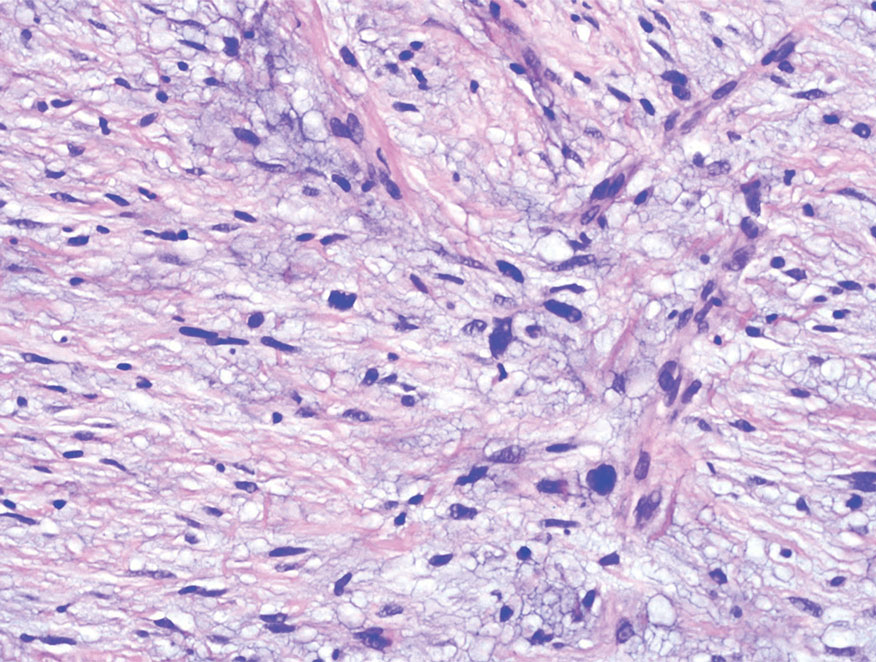 Desmoplastic melanoma