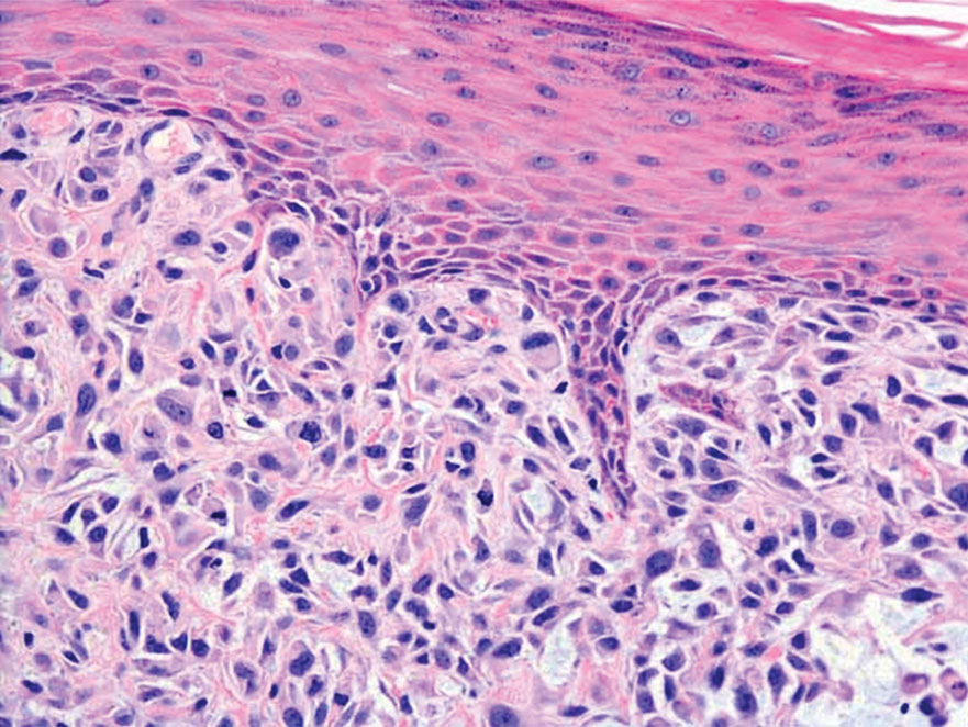 Spindle cell squamous cell carcinoma