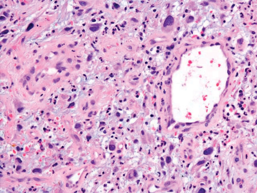 Undifferentiated pleomorphic sarcoma