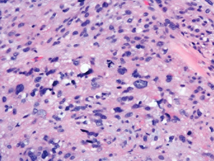 Firm Exophytic Tumor on the Shin | MDedge