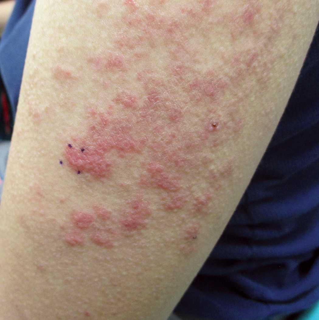 Bullous Systemic Lupus Erythematosus Successfully Treated With 