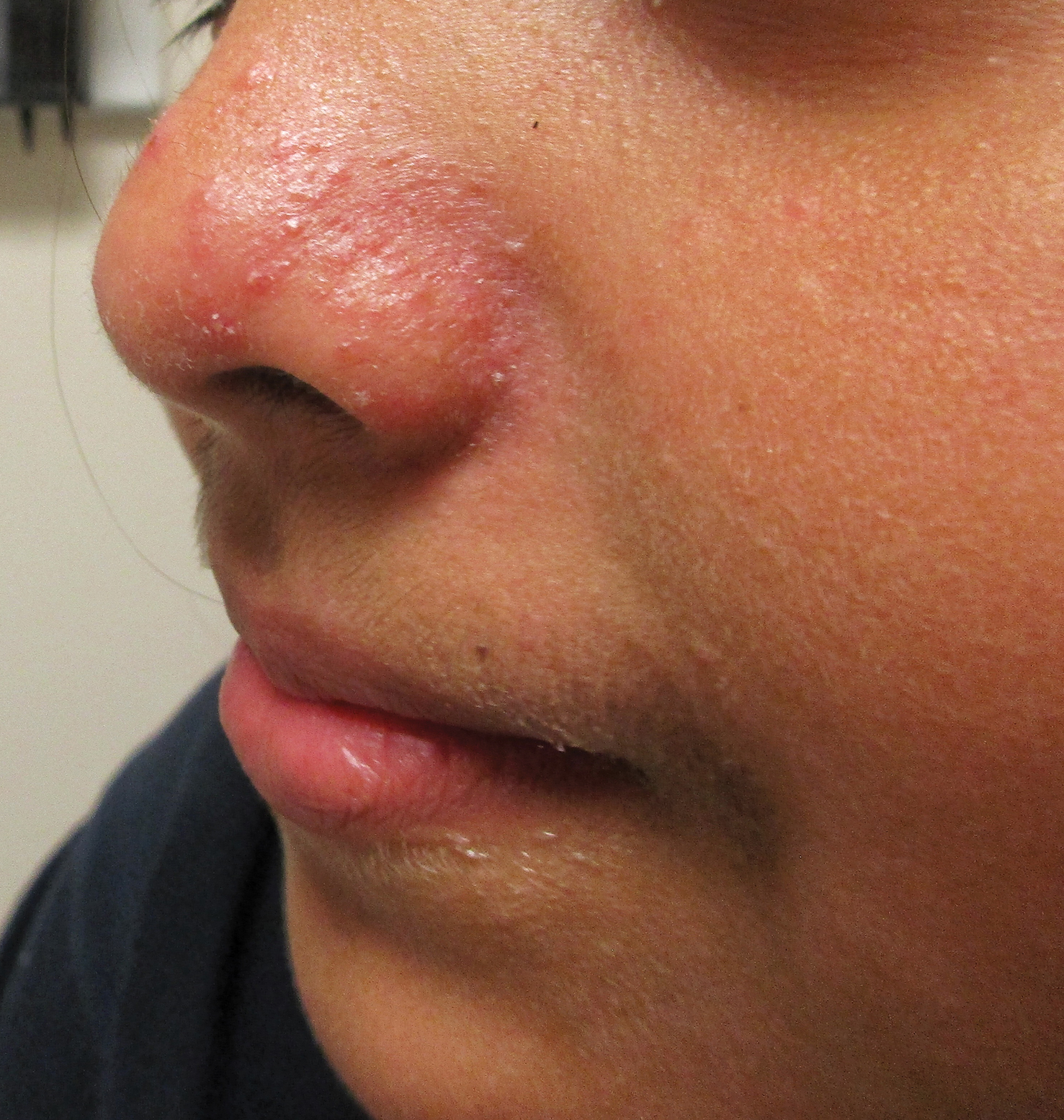 Erythematous Papules And Pustules On The Nose MDedge Dermatology