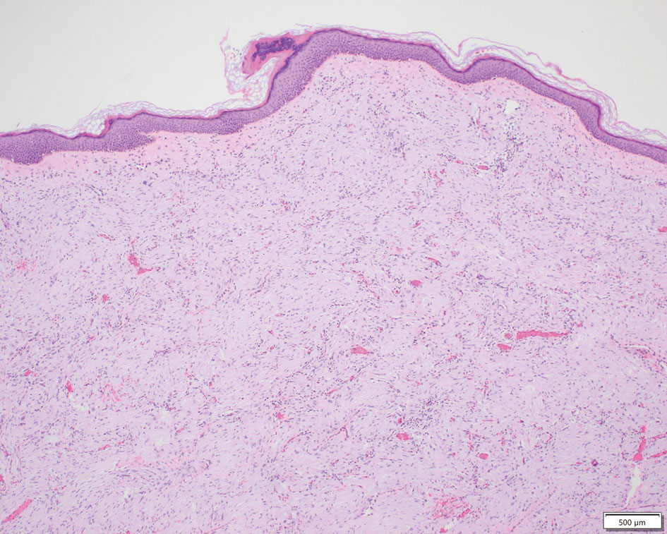 Proliferation of spindle cells involving the reticular dermis (H&E, original magnification ×200). Reference bar indicates 500 µm.