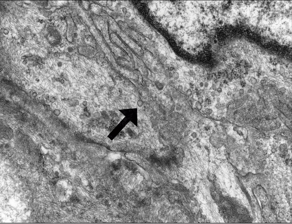 Electron microscopy showed long, slender, cytoplasmic processes coated by discontinuous basal lamina and the presence of many pinocytic vesicles (black arrow)(original magnification ×15,000).