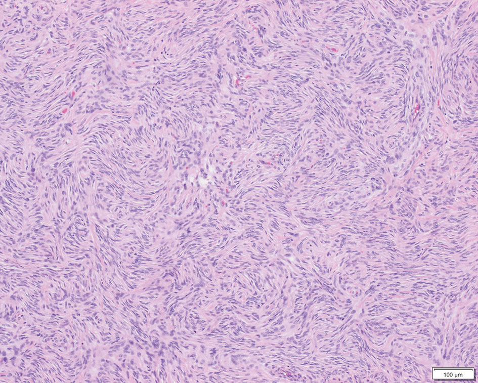 Spindle cell proliferation with storiform and whorled patterns (H&E, original magnification ×100). Reference bar indicates 100 µm.