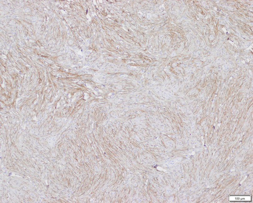 Immunohistochemistry revealed epithelial membrane antigen positivity in spindle cells (original magnification ×100). Reference bar indicates 100 µm.