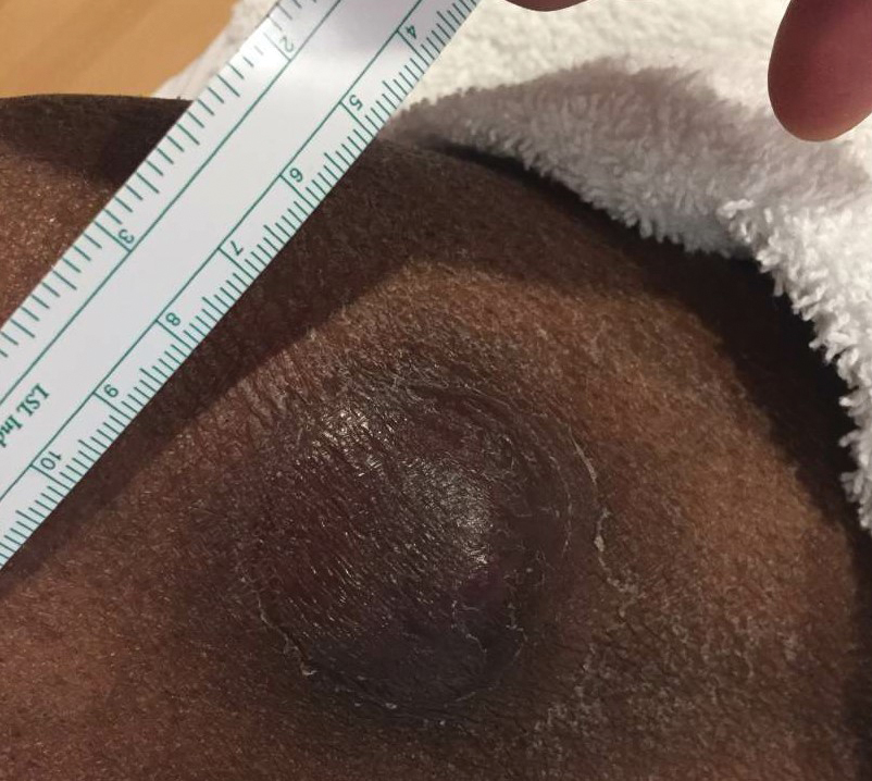 A brown, indurated, dome-shaped plaque on the inferomedial right thigh. No erythema, warmth, or fluctuance was present.