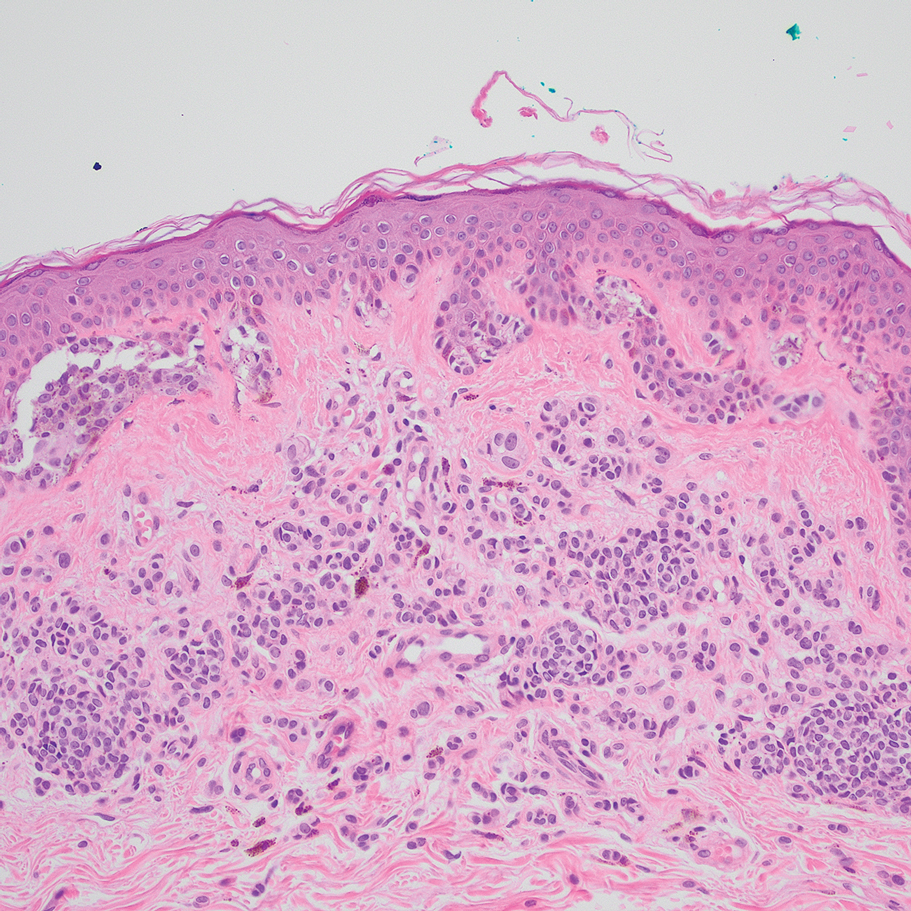 Special-site nevus histopathology showing a compound nevus with mild melanocyte cytologic atypia and architectural distortion at center of lesion