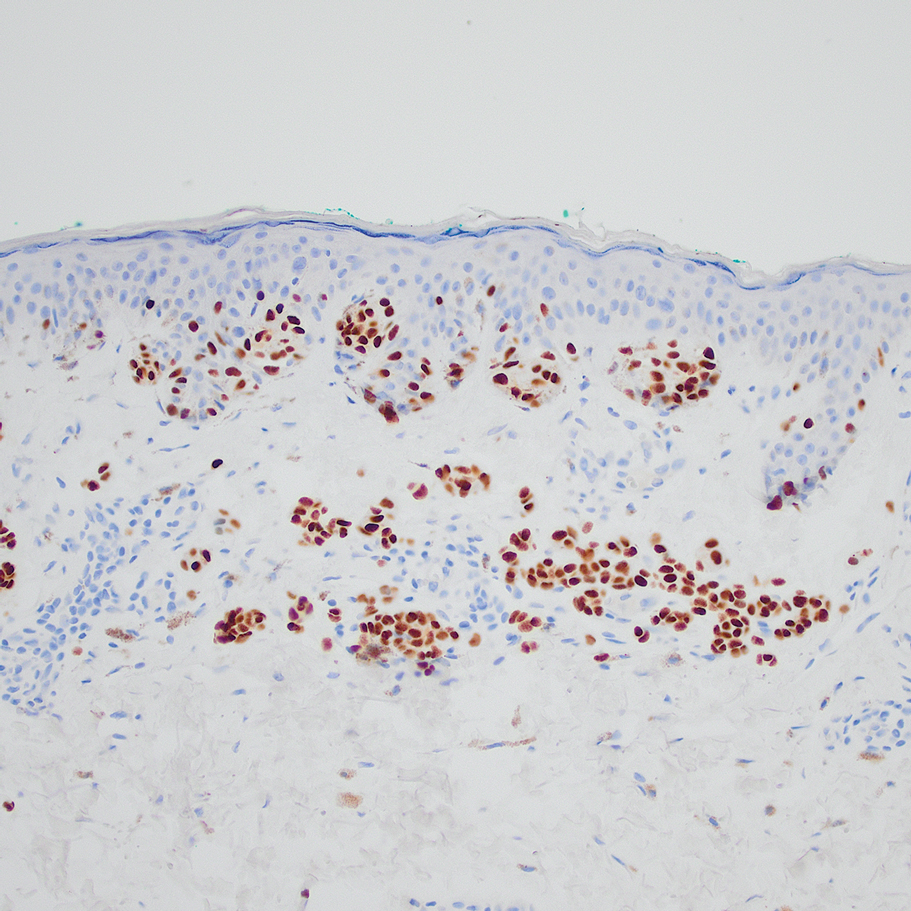 Special-site nevus histopathology with SOX10 stain highlighting the melanocytic proliferation