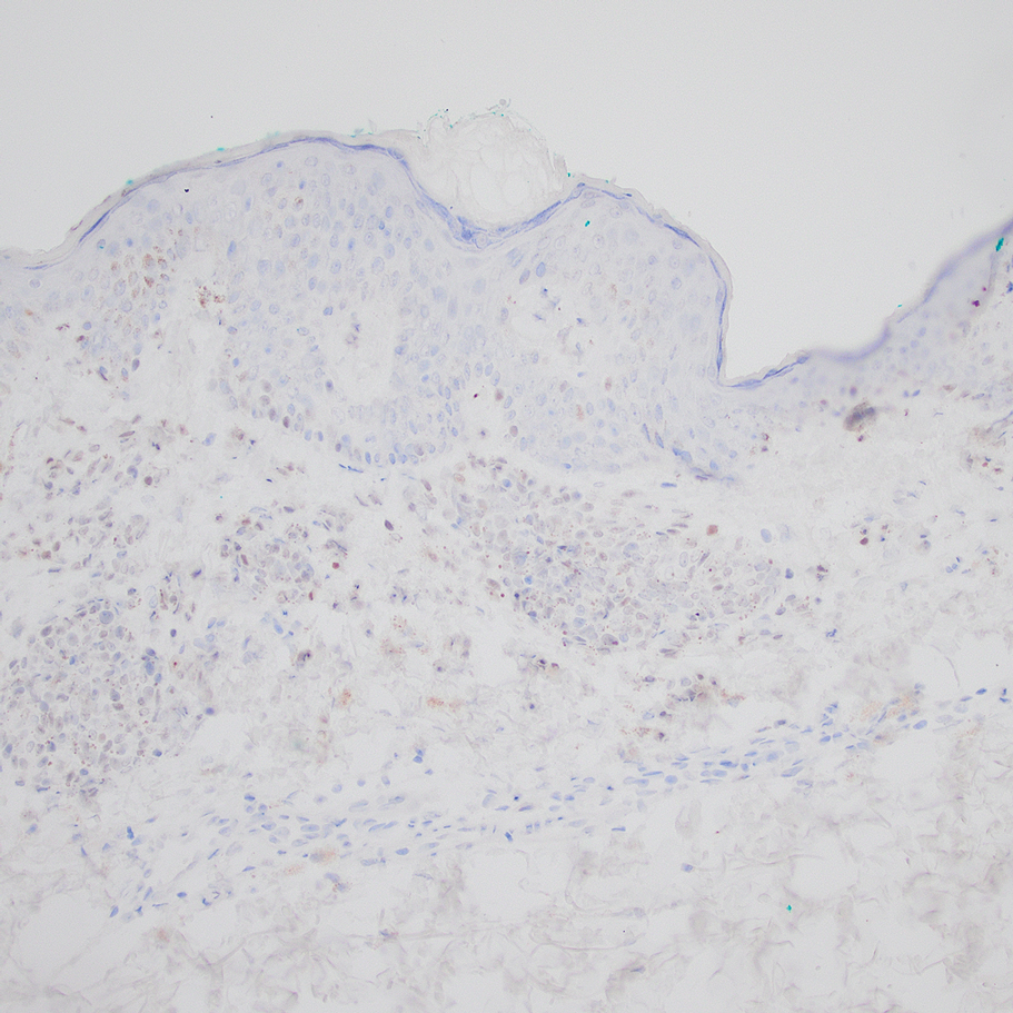 Special-site nevus histopathology stained positive for preferentially expressed antigen of melanoma