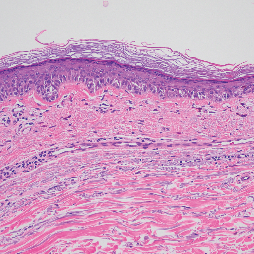 Melanoma in situ histopathology showed a highly atypical melanocytic proliferation at the base of the epidermis that does not cross the dermoepidermal junction, supporting an in-situ diagnosis