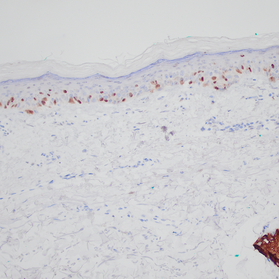 Melanoma in situ histopathology stained positive for preferentially expressed antigen of melanoma (PRAME), which highlights the malignant melanocytes in the epidermis, supporting the diagnosis of melanoma in situ